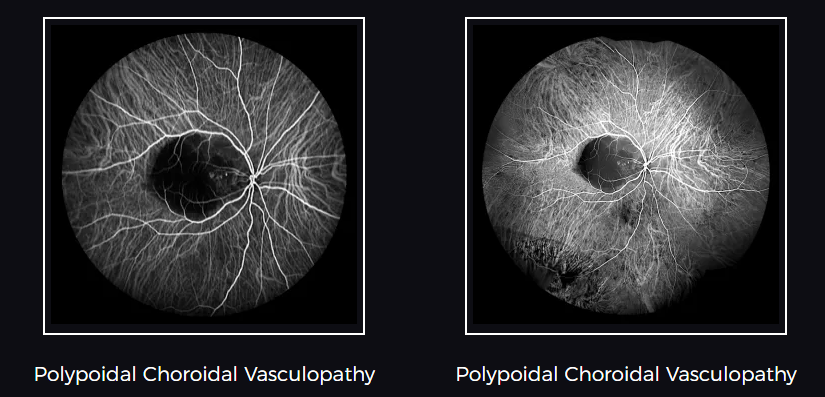 Indocyanine Green Angiography