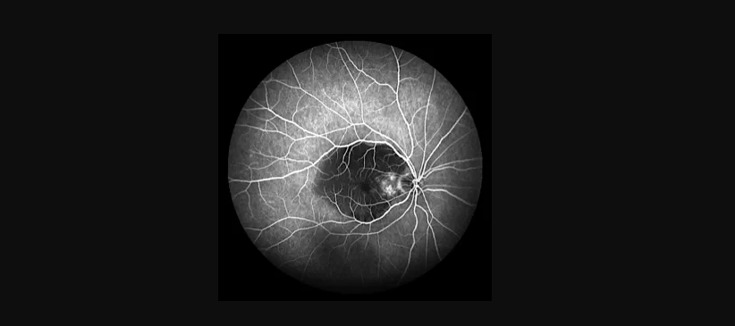 What is a Retinal Scan? Supply