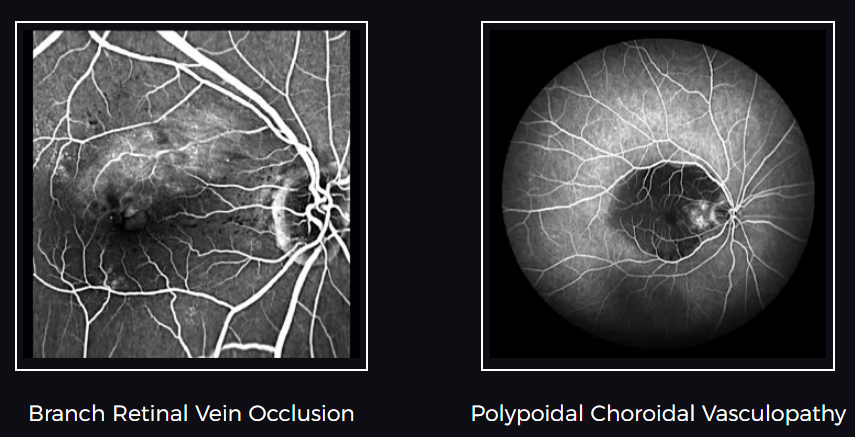 Non Mydriatic Retinal Camera