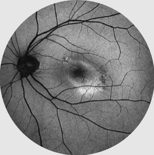 Non-Mydriatic Retinal Camera