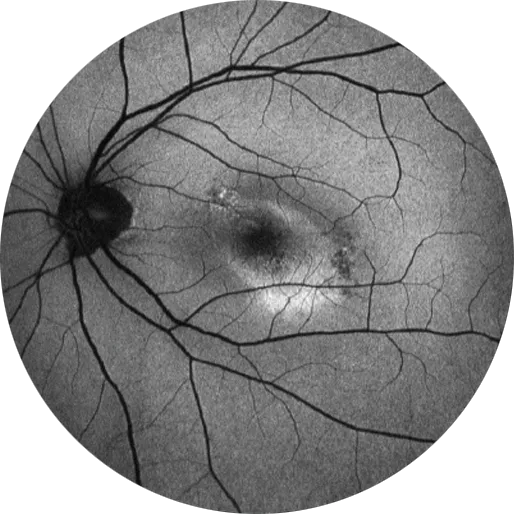 AF 150° quick retina health assessment