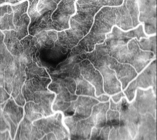 Full fledged Fluorescein Angiography