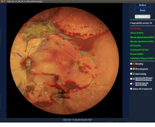 Microclear Retina Assistant