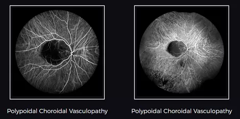 What Is the Use of Indocyanine Green Angiography?