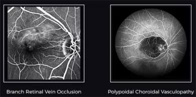 Mydriatic or Non Mydriatic Fundus Camera, Which Is Better?