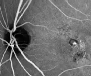 Indocyanine Green Angiography