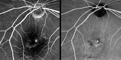 What is the difference between OCT and fundus photography?