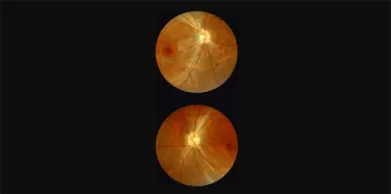 Retinal Imaging: How It Works and Why It's Important