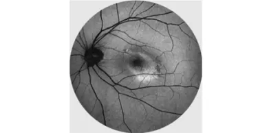 What is a Non-Mydriatic Retinal Camera?