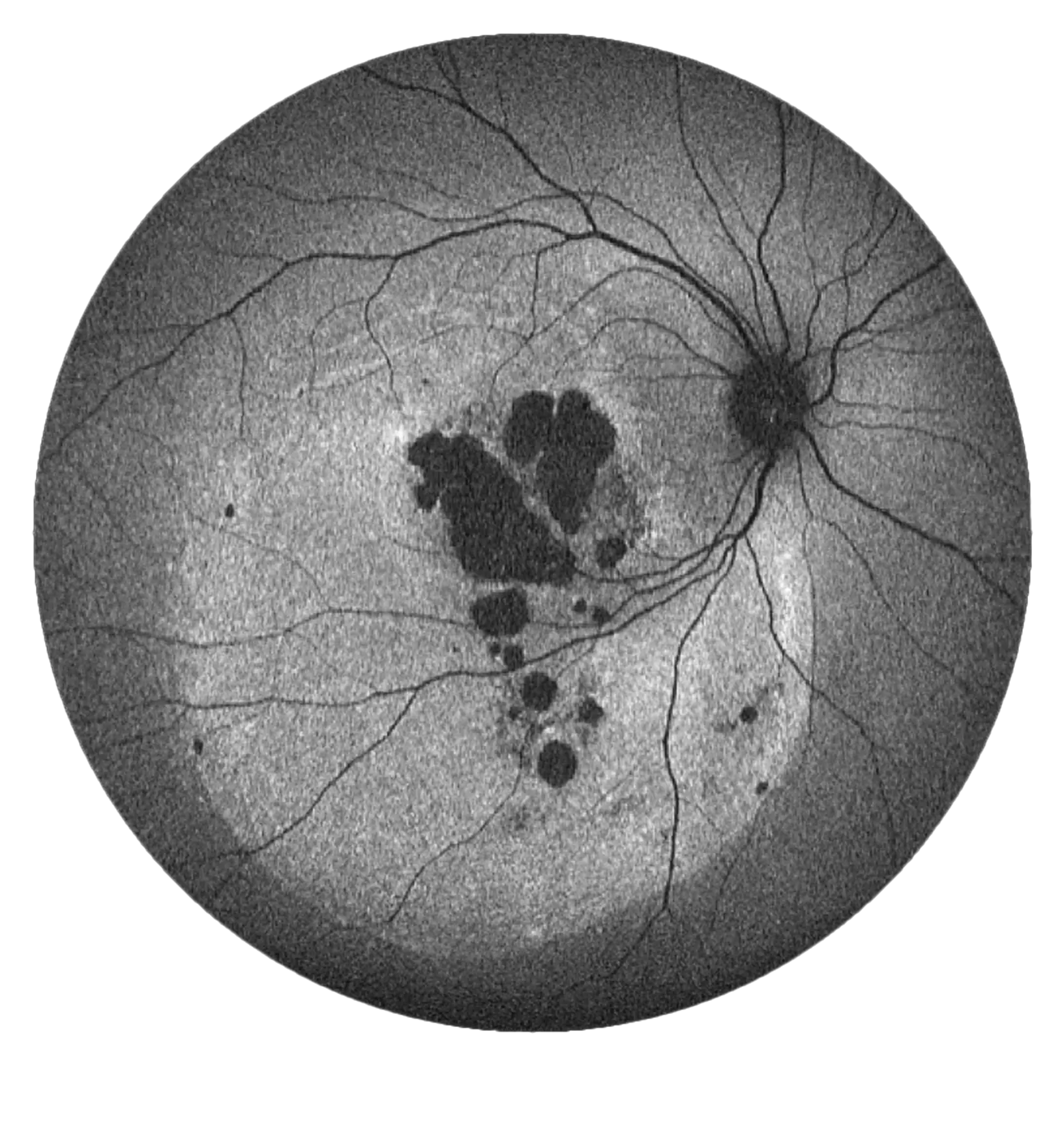 AF 165° quick retina health assessment