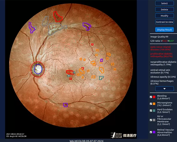 INCLUDED IN ALL MICROCLEAR RETINAL DEVICES.